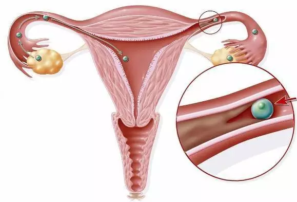 輸卵管不通,重慶送子鳥(niǎo)醫(yī)院